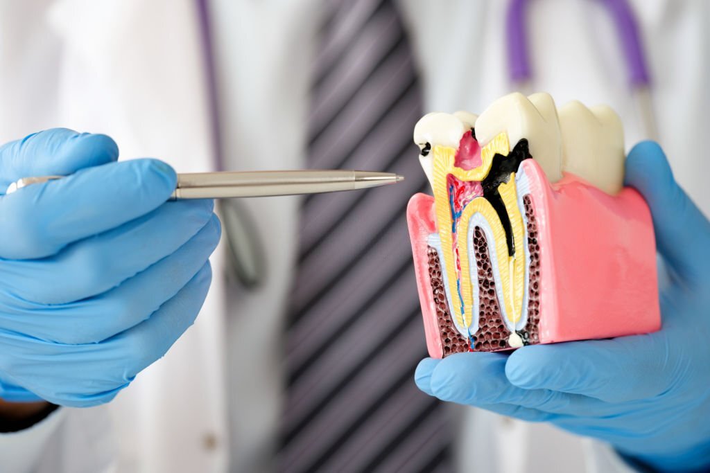 Caria dentara – cea mai comuna problema stomatologica si cum este aceasta tratata